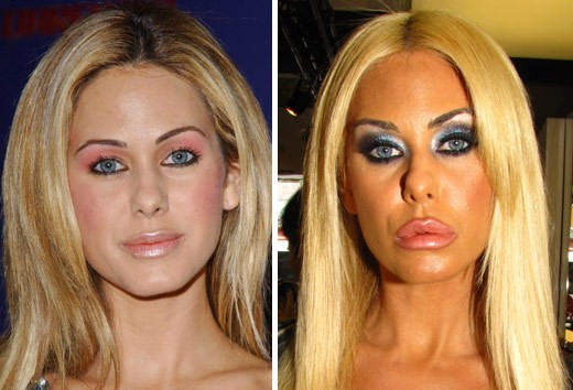 shauna-sand from http://www.plasticcelebritysurgery.com